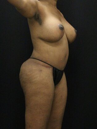 Tummy Tuck: Case 73 - After