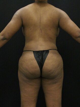 Tummy Tuck: Case 73 - After