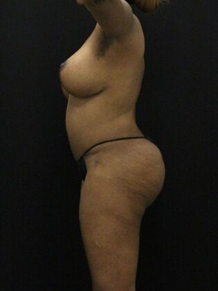 Tummy Tuck: Case 73 - After