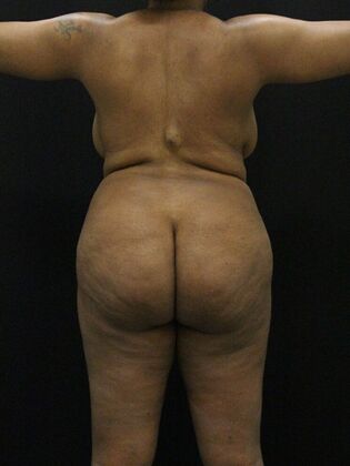 Liposuction Case 60 - Before