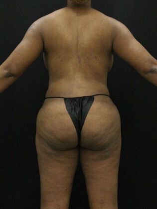 Liposuction Case 60 - After
