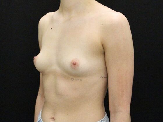 Breast Augmentation: Case 54 - Before