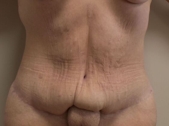 Tummy Tuck (Abdominoplasty) Case 546 - Before