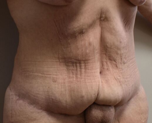 Massive Weight Loss : Case 183 - Before