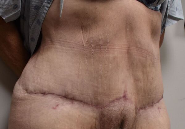 Massive Weight Loss : Case 183 - After