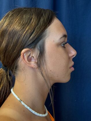 Chin Augmentation*: Case 3 - Before