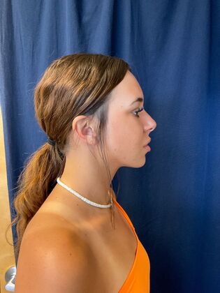 Chin Augmentation*: Case 3 - After