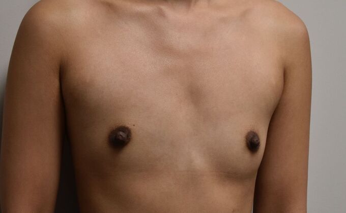 Breast Augmentation: Case 801 - Before
