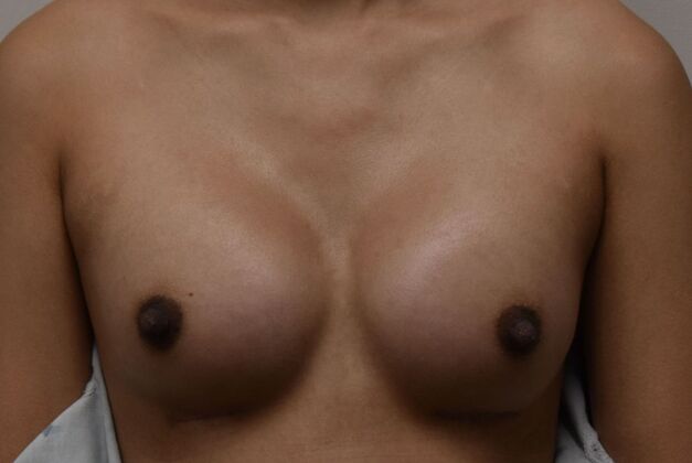 Breast Augmentation Case 801 - After