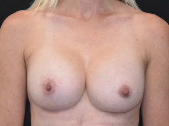 Breast Augmentation Case 24 - After