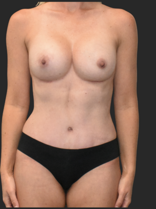 Mommy Makeover Case 16 - After