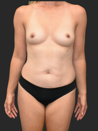 Mommy Makeover Case 16 - Before