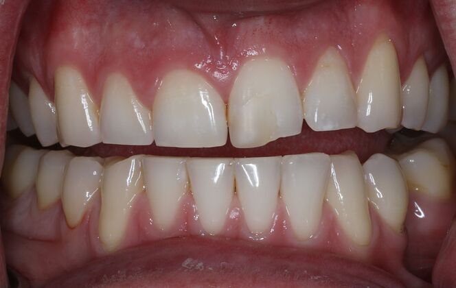 Dental Bonding Case 8 - Before