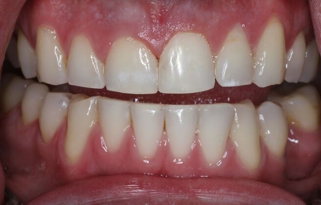 Dental Bonding Case 8 - After