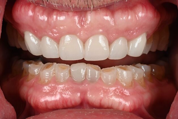 Prepless Veneers Case 1 - Before