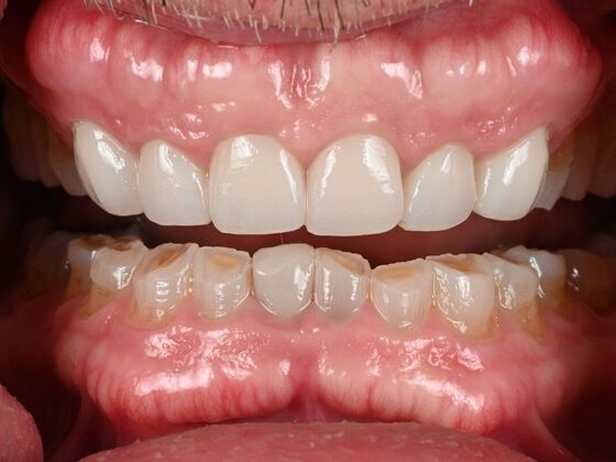 Prepless Veneers Case 1 - Before
