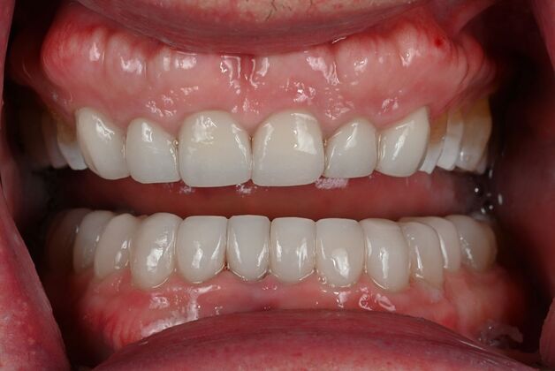 Prepless Veneers Cases