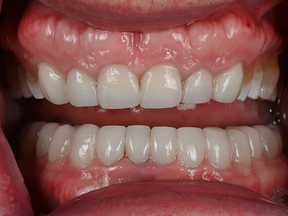 Prepless Veneers Case 1 - After