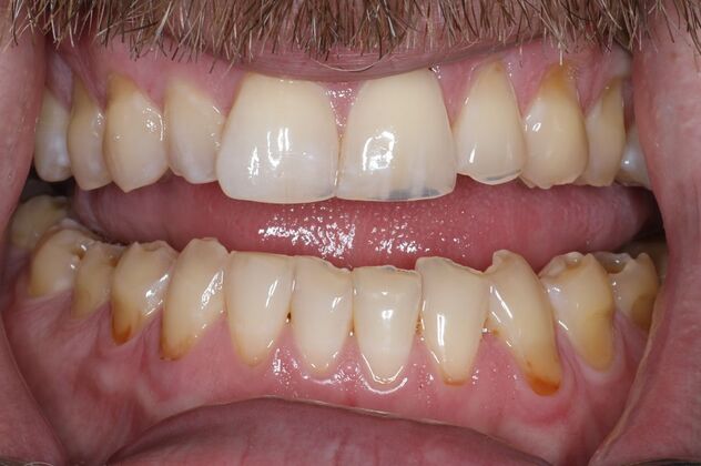 Prepless Veneers Case 2 - Before