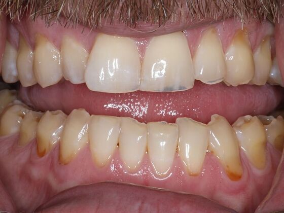 Prepless Veneers Case 2 - Before