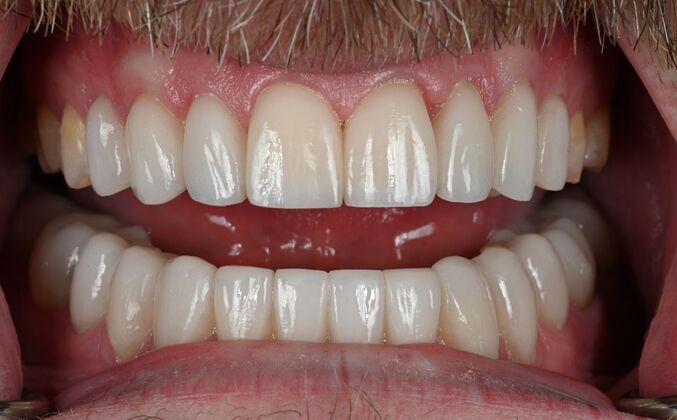 Prepless Veneers Case 2 - After