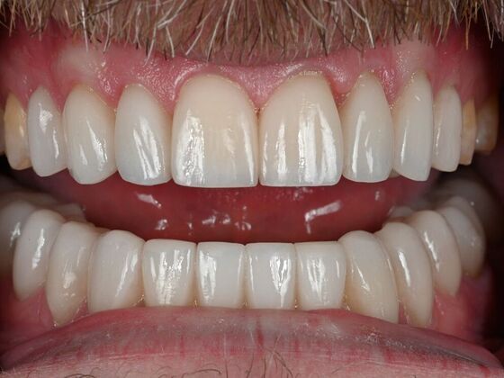 Prepless Veneers Cases