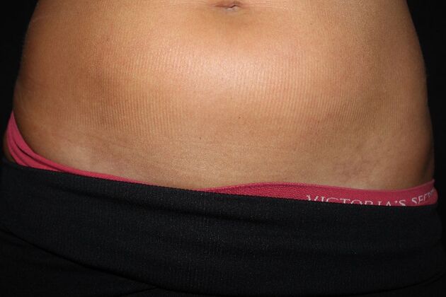 Laser Tattoo Removal Case 43 - After