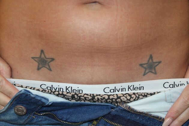 Laser Tattoo Removal Case 43 - Before