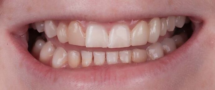 Smile Makeover & Veneers: Tiffani - Before