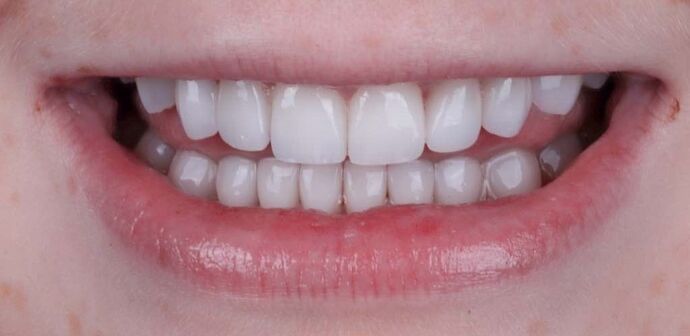 Smile Makeover & Veneers: Tiffani - After