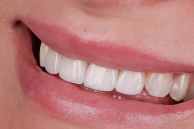 Smile Makeover & Veneers: Georgina - After