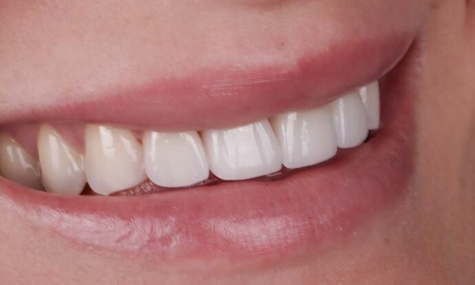 Smile Makeover & Veneers: Georgina - After