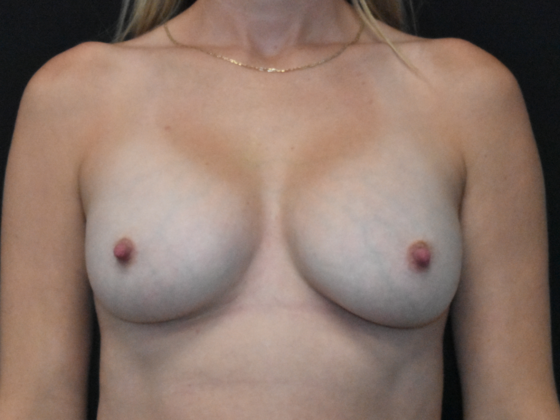 Breast Augmentation Case 25 - After