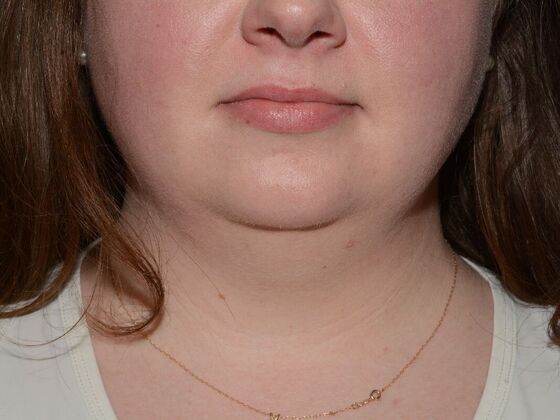 Liposuction: Case 19 - Westfield - Before