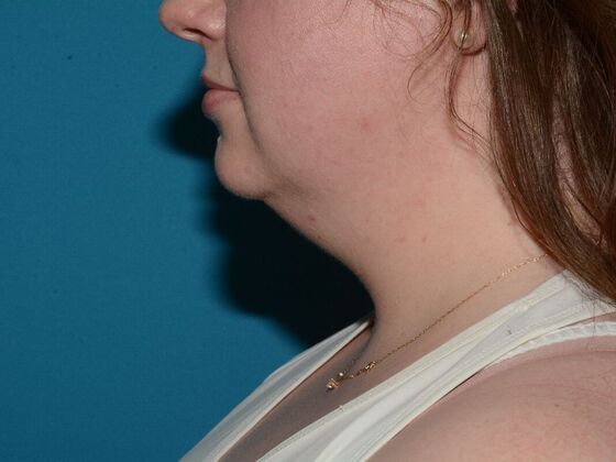 Liposuction: Case 19 - Westfield - Before