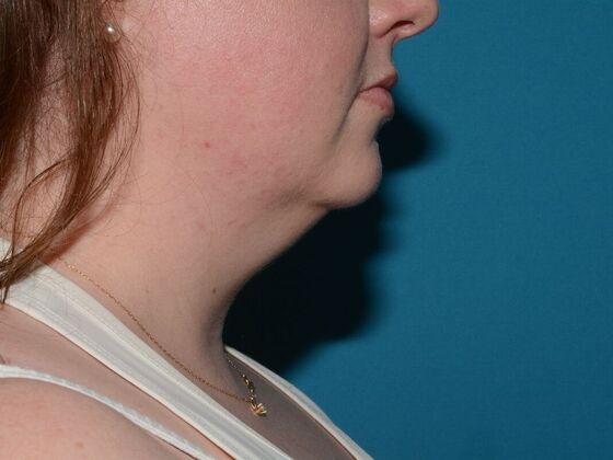 Liposuction: Case 19 - Westfield - Before