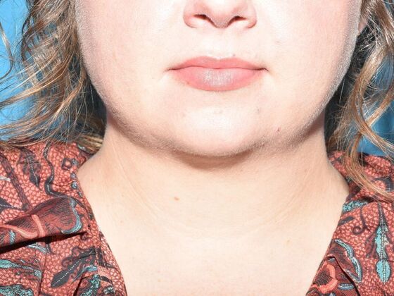 Liposuction: Case 19 - Westfield - After