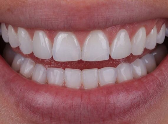 Smile Makeover & Veneers: Sammy - After