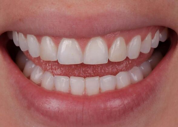 Smile Makeover & Veneers: Sammy - Before