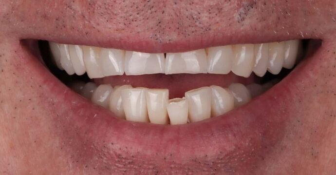 Smile Makeover & Veneers: Stephen - Before