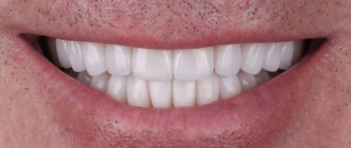 Smile Makeover & Veneers: Stephen - After