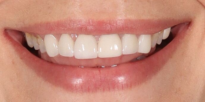 Smile Makeover: Abbie - Before