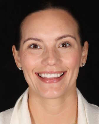 Smile Makeover Abbie - Before