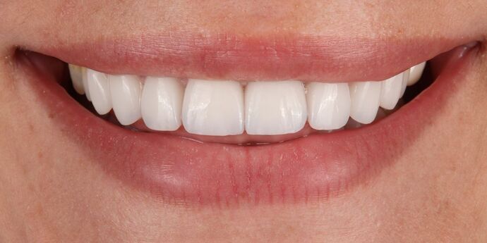 Smile Makeover: Abbie - After