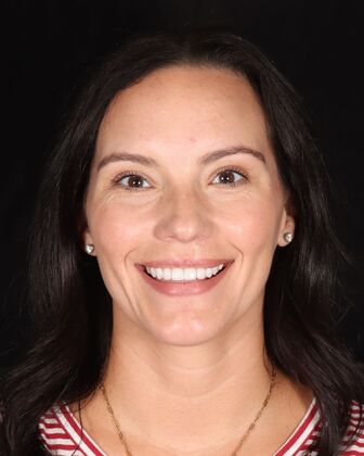 Smile Makeover Abbie - After