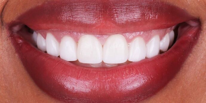 Smile Makeover: Antionette - After