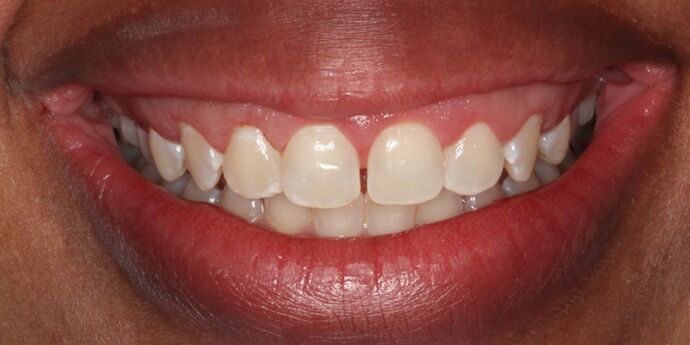 Smile Makeover: Antionette - Before