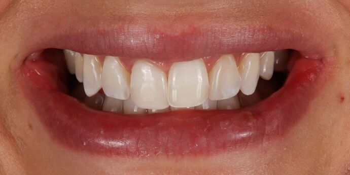 Smile Makeover: Ashley - Before