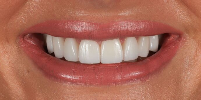 Smile Makeover: Ashley - After