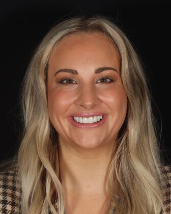 Smile Makeover Ashley - After